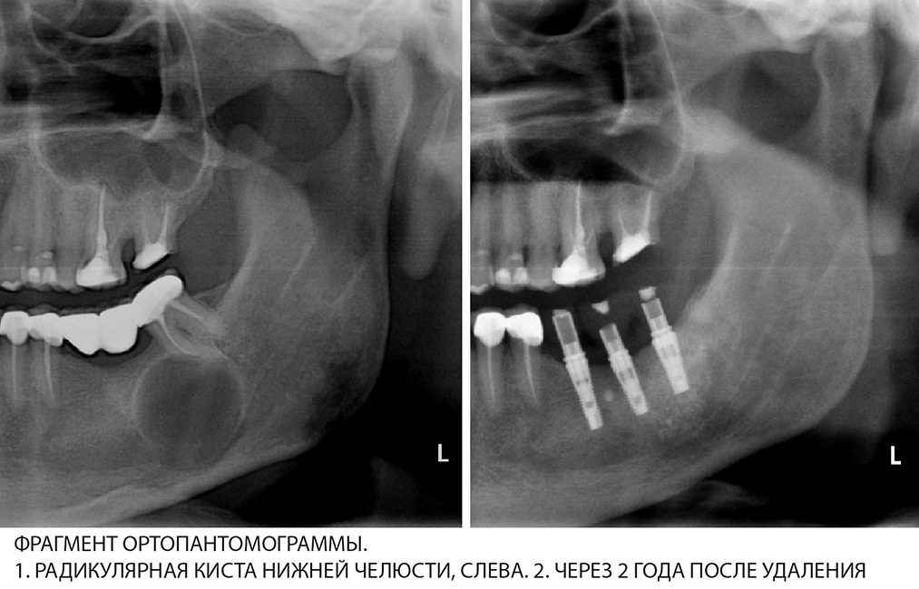 Удаление кисты зуба Томск Тютчева Лечение периодонтита Томск Ватутина