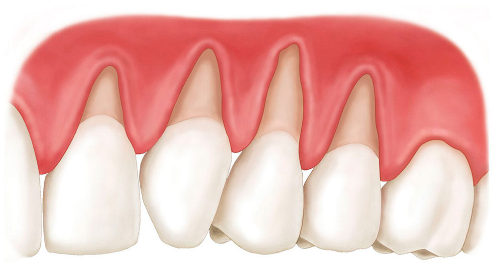 Wedgeshaped defects of teeth (*Клиновидные дефекты зубов)