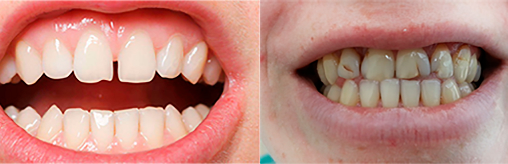 Изгиб зубов. Трещины на зубах вертикальные. Трескаются зубы в 28 лет лицо округляется. Лечение трещины через весь зуб до и после фото.