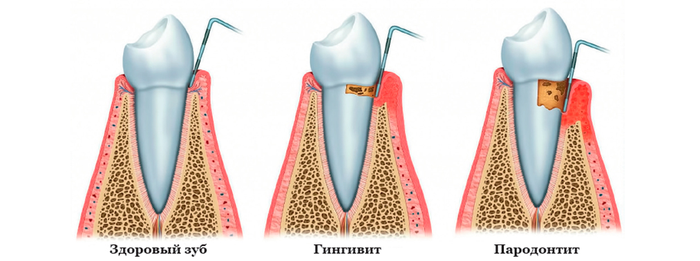Сергей Сергеевич, что такое пародонтит, и в чём заключается его ...