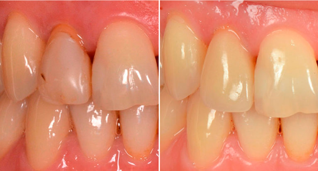 Клиновидные дефекты зубов