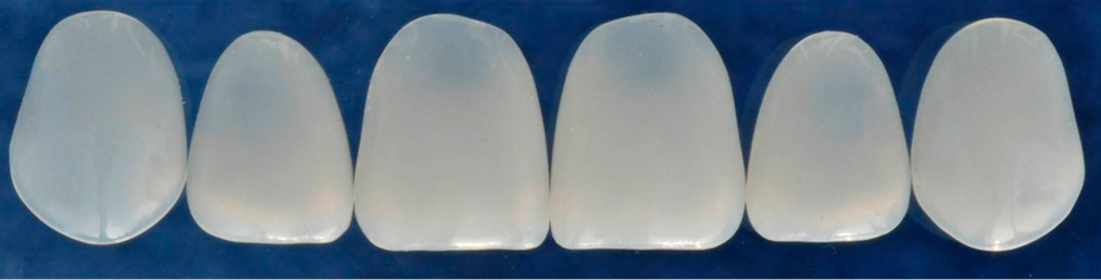 Клиновидные дефекты зубов