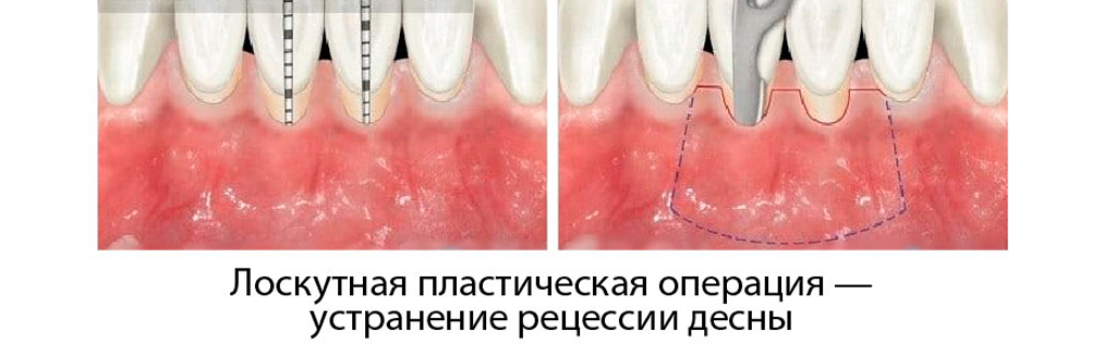 Рецессия десны: почему опускаются или поднимается десна и что делать?