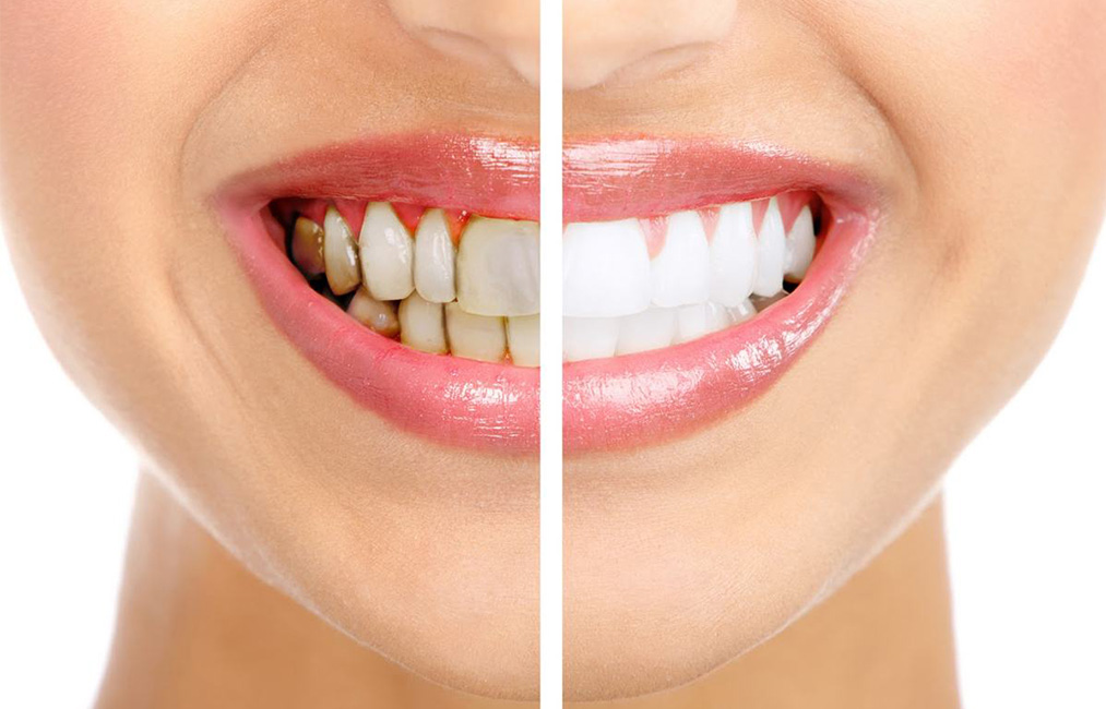 Абсцесс зуба - причины появления, методы лечения в клинике и дома — ROOTT