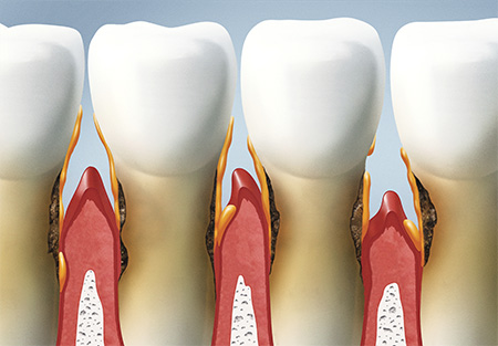Вектор в стоматологии противопоказания