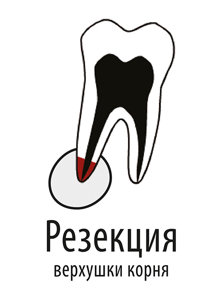 Зубосохраняющие операции показания противопоказания