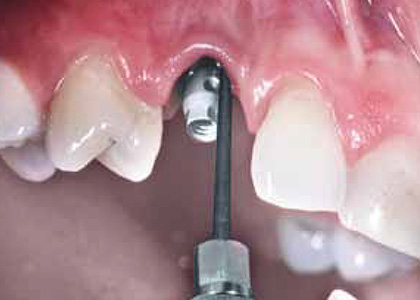 Аппарат вектор в стоматологии показания и противопоказания