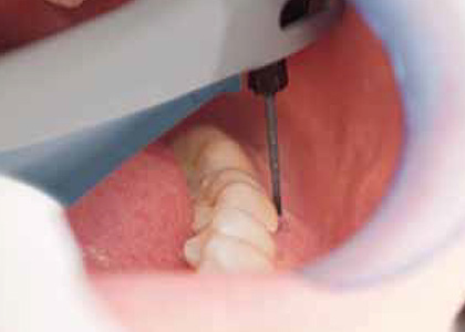 Вектор для зубов противопоказания
