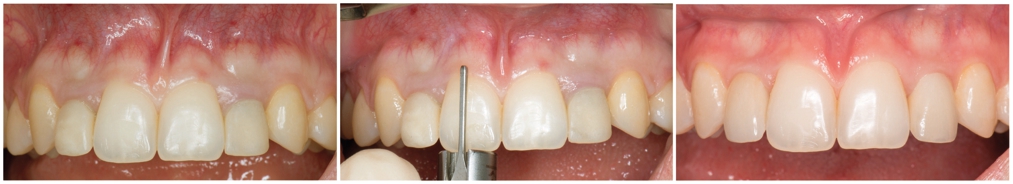 Эстетическая стоматология - новое направление стоматологии