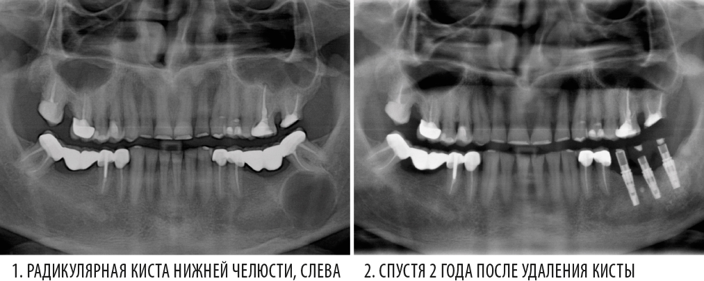 Зубосохраняющие операции показания противопоказания