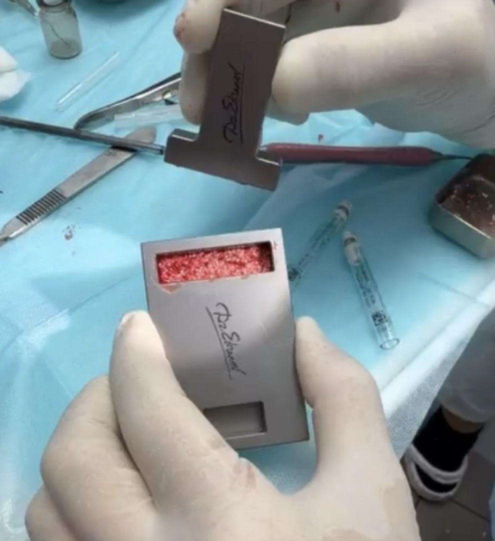 Отзыв о применении компресс-формера доктора Едранова