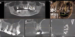 Удаление зубов. Современный подход. Теория и практика